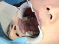 歯フェチ！処置室 ゆうこちゃん 銀歯がキラリ 4