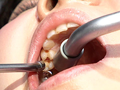 口腔：ガチ歯科治療美少女若菜しずく銀歯2箇所埋め込み治療