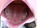 ガチ歯科治療美少女若菜しずく銀歯2箇所埋め込み治療 サンプル画像0005