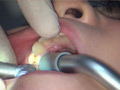 ガチ歯科治療美少女若菜しずく銀歯2箇所埋め込み治療 サンプル画像0009