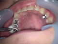 ガチ歯科治療美少女若菜しずく銀歯2箇所埋め込み治療 サンプル画像0010