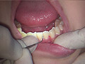歯フェチ！本物歯治療映像虫歯掘削処置 堀越まき | 無料