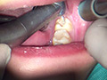 本物歯科治療映像 左下6，7番銀歯治療 星野桃子 星野桃子