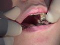 歯フェチ！本物歯科治療映像 親知らず抜歯 芹沢かえで 芹沢かえで