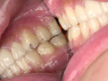 [adoa-0700] 人気女優 蘭々チャンの歯・口内のどちんこ観察！！のキャプチャ画像 4