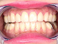 [adoa-0851] 蘭々チャンの歯・銀歯・口内・のどちんこを超観察！！！のキャプチャ画像 5