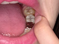 蘭々チャンの歯・銀歯・口内・のどちんこを超観察！！！ サンプル画像12