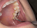 最新の宮沢ちはるチャンの口内・歯・のどちんこ観察 画像9
