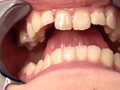 [adoa-1078] 橋本りこチャンの歯・口内・舌ベロ観察プレイ！！！のキャプチャ画像 3