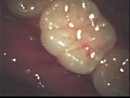 歯11のサンプル画像5