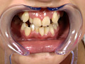歯13 サンプル画像4