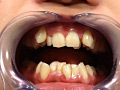 歯13 サンプル画像5
