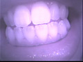 歯16のサンプル画像12