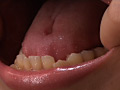 歯17のサンプル画像3