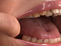 歯17のサンプル画像4