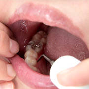 銀歯インレーフェチ 咲希の口内には銀歯がいっぱい！