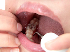 口腔：銀歯インレーフェチ 咲希の口内には銀歯がいっぱい！