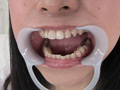 銀歯インレーフェチ 咲希ちゃんの口内には銀歯がいっぱい！...thumbnai2