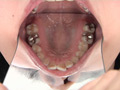 銀歯インレーフェチ 咲希の口内には銀歯がいっぱい！