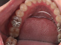 [fetishjapan-0772] 銀歯インレーフェチ 咲希の口内には銀歯がいっぱい！ 横尾咲希のキャプチャ画像 4