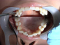歯フェチ！処置室 つぐみちゃん 銀歯がキラリ サンプル画像4