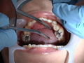 歯フェチ！処置室 つぐみちゃん 銀歯がキラリ サンプル画像5