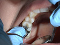 歯フェチ！処置室 つぐみちゃん 銀歯がキラリ サンプル画像7