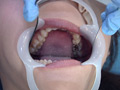 歯フェチ！処置室 さらちゃん 銀歯がキラリ サンプル画像5