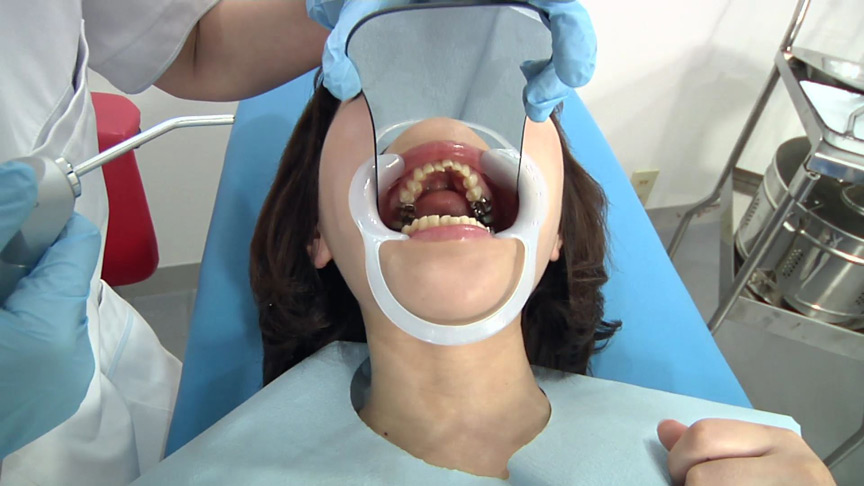 歯フェチ！処置室 ゆうこちゃん 銀歯がキラリ-5