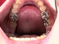 [fetishjapan-0867] 銀歯フェチ！口内歯観察 安達まどかのキャプチャ画像 5
