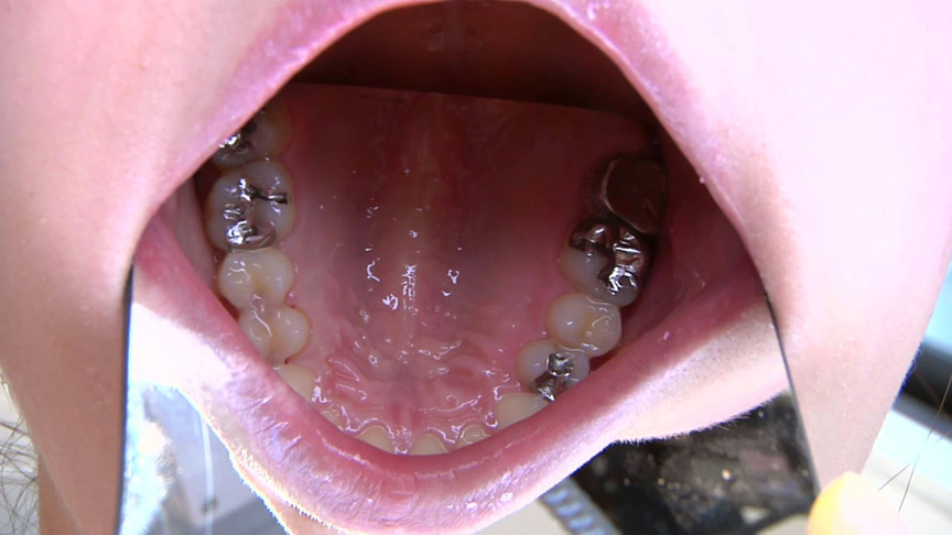 ガチ歯科治療美少女若菜しずく銀歯2箇所埋め込み治療-5