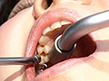 [fetishjapan-0869]ガチ歯科治療美少女若菜しずく銀歯2箇所埋め込み治療