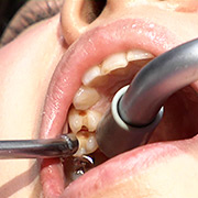 ガチ歯科治療美少女若菜しずく銀歯2箇所埋め込み治療