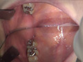 ガチ歯科治療美少女若菜しずく銀歯2箇所埋め込み治療 画像3