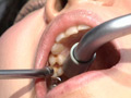 ガチ歯科治療美少女若菜しずく銀歯2箇所埋め込み治療 画像4