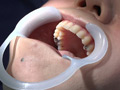 ガチ歯科治療美少女若菜しずく銀歯2箇所埋め込み治療 画像7