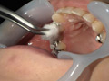 ガチ歯科治療美少女若菜しずく銀歯2箇所埋め込み治療 サンプル画像8