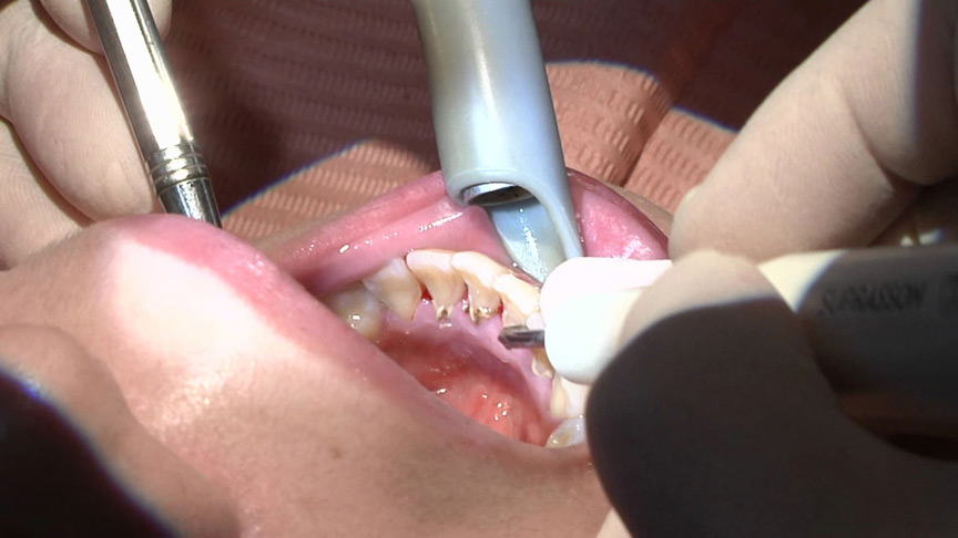 ガチ歯科治療歯周病？歯肉縁下歯石除去 星野桃子 | アダルトガイドナビ