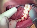 [fetishjapan-0870]ガチ歯科治療歯周病？歯肉縁下歯石除去 星野桃子