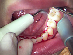 【エロ動画】ガチ歯科治療歯周病？歯肉縁下歯石除去 星野桃子のシコれるエロ画像