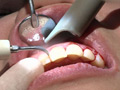 ガチ歯科治療歯周病？歯肉縁下歯石除去 星野桃子 サンプル画像2
