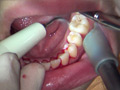 [fetishjapan-0870] ガチ歯科治療歯周病？歯肉縁下歯石除去 星野桃子のキャプチャ画像 3