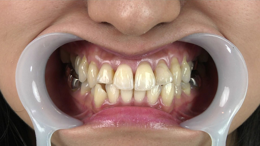 銀歯フェチ歯観察 由香里さんの口内 | DUGAエロ動画データベース
