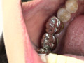 銀歯フェチ歯観察 由香里さんの口内 サンプル画像4