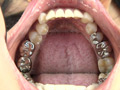 銀歯フェチ歯観察 由香里さんの口内 サンプル画像5