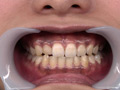 [fetishjapan-0897] エリナちゃんの歯観察 『左上5番：涙の崩壊歯』 小田エリナのキャプチャ画像 2
