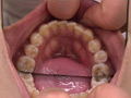 [fetishjapan-0897] エリナちゃんの歯観察 『左上5番：涙の崩壊歯』 小田エリナのキャプチャ画像 4
