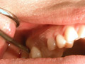 歯フェチ！本物の歯治療映像【抜歯】 ミランダ サンプル画像5