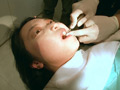 歯フェチ！本物の歯治療映像【抜歯】 ミランダ サンプル画像6