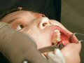 歯フェチ！本物の歯治療映像【抜歯】 ミランダ サンプル画像7